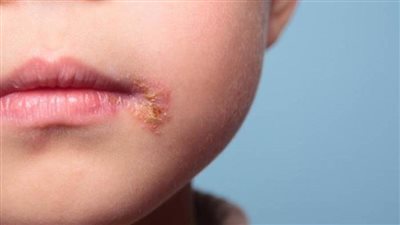 بعد تحذير وزارة الصحة.. 13 معلومة عن فيروس الهربس الفموي الذي يصيب الأطفال