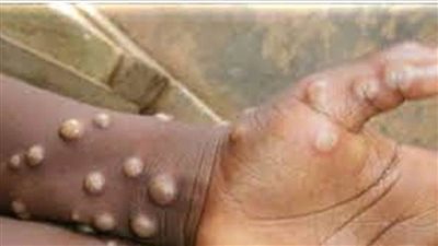 الهند تسجل أول وفاة محتملة بجدري القردة