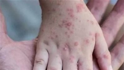 إندونيسيا تكثف الإجراءات الطبية بعد رصد حالة مصابة بفيروس 