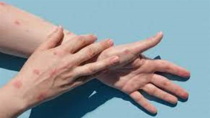 جدري القردة