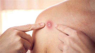 نيويورك تعلن أول حالة إصابة بجدري القرود لدى 