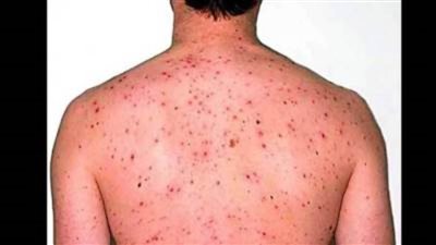 عزل أول إصابة بـ