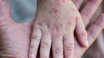 الصحة: عزل أول حالة مصابة بجدري القرود لمصري من الحاصلين على الإقامة بإحدى الدول الأوربية