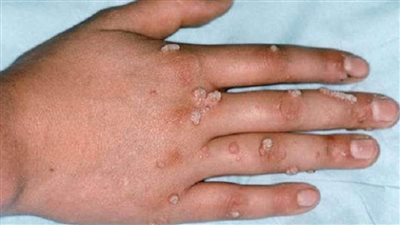 الأردن يعلن تسجيل أول إصابة بجدري القردة