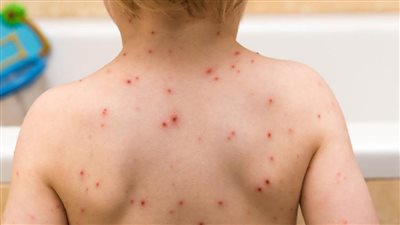 روسيا تعلن تسجيل ثاني حالة إصابة بجدري القردة