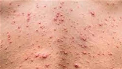 ارتفاع حالات الإصابة بجدري القردة في الولايات المتحدة إلى أكثر من 21 ألف حالة