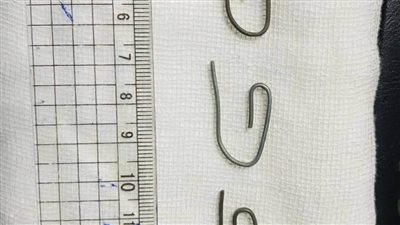 استخراج 5 دبابيس ستائر معدنية من معدة رضيع بمستشفى أطفال المنصورة 