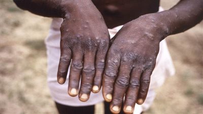 السودان يسجل 5 إصابات جديدة بجدري القردة في 4 ولايات