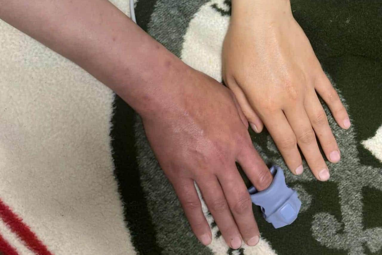 احدي حالات اللدغ التي أنقذها فريق التطوع الأردني لعشاق الافاعي، والصورة توضح تأثير اللدغة علي اليد المصابة مقارنة باليد الأخري