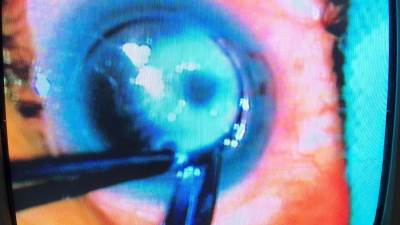 محافظ المنيا يشيد بنجاح عمليتين لزرع القرنية ضمن المبادرة الرئاسية «القضاء على قوائم الانتظار»