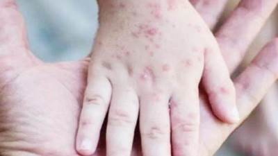 الإعلان عن أول حالة إصابة بفيروس "جدري القردة" في روسيا