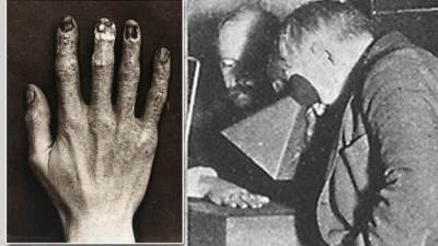 تجربة مأساوية.. كيف أدت الأشعة السينية إلى وفاة مساعد إديسون "صور"