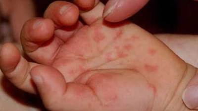 متحدث "الصحة": فيروس HFMD يشفي من تلقاء نفسه.. وغير معدٍ