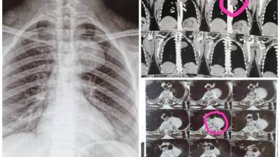 مستشفيات جامعة أسيوط تعلن نجاح فريق طبي بإنقاذ حياة أم وجنينها